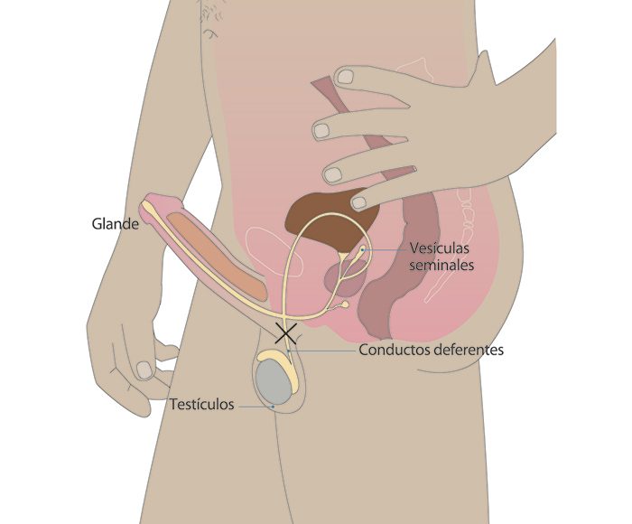vasectomia