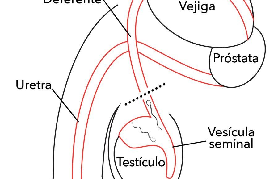 vasectomy-spanish-whitebg.jpg__1200x900_q75_subsampling-2
